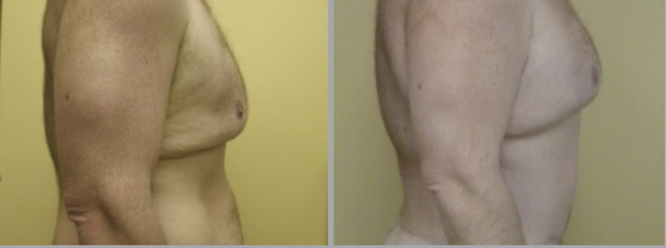 Lower Body Lift in Ventura, CA